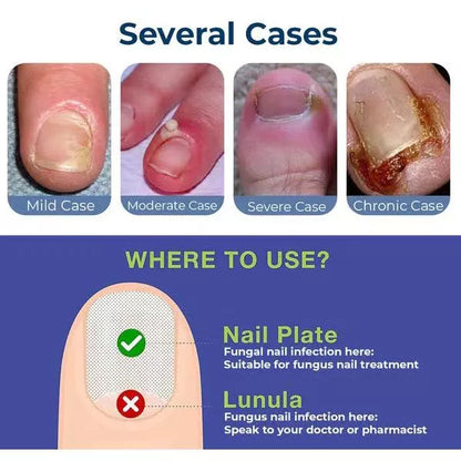 Anti Paronychia Relief Oil ( BUY 1 GET 1 FREE )