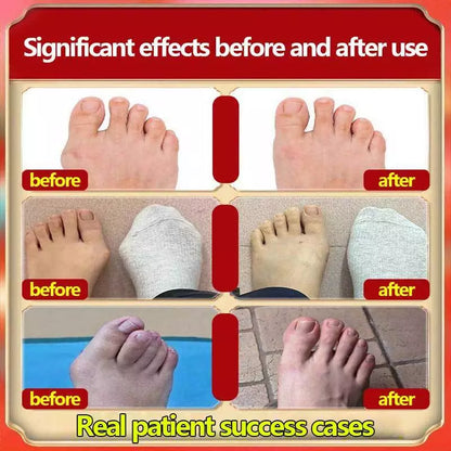 Bunion Joint pain relief cream(BUY 1 GET 1 FREE)